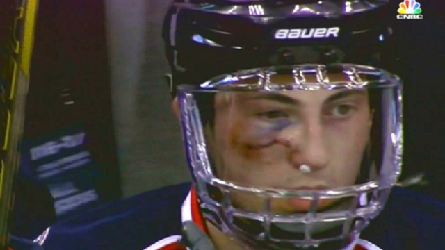 Blue Jackets\' Zach Werenski Returns To Game After Taking Puck To The Face Like It\'s No Big Deal